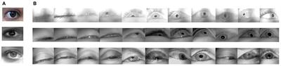 Eyelid and Pupil Landmark Detection and Blink Estimation Based on Deformable Shape Models for Near-Field Infrared Video